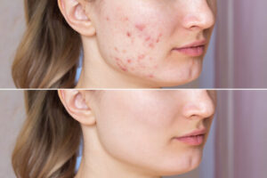 Acne Treatment Before and After Malad Mumbai