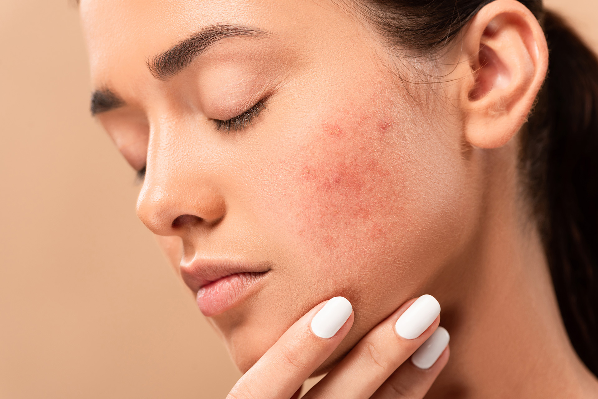 Best Pigmentation Peel Cosmelana Peel Clinic Malad Mumbai