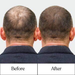 Cosderma_Clinic_Before_After_1