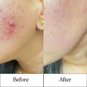Cosderma_Clinic_Before_After_5