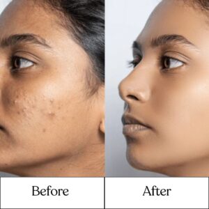 Cosderma_Clinic_Before_After_6