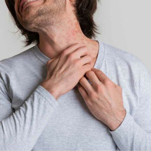 Best Skin Allergy Clinic Malad mumbai
