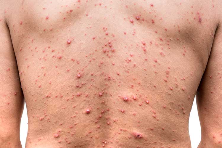 Skin Rash Diagnosis treatment Malad Mumbai