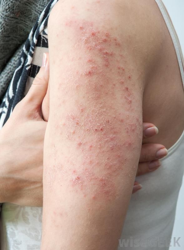 Before & after treatment of ringworm
