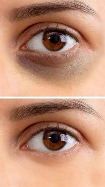 Best Dark Circles Clinic Malad mumbai