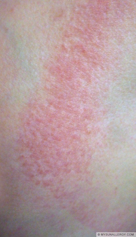 Skin Allergy Treatment Before After Mumbai