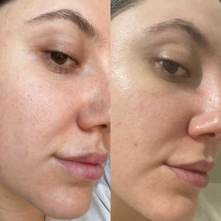 Skin lightening whitening Brightening Treatment Before After Malad Mumbai