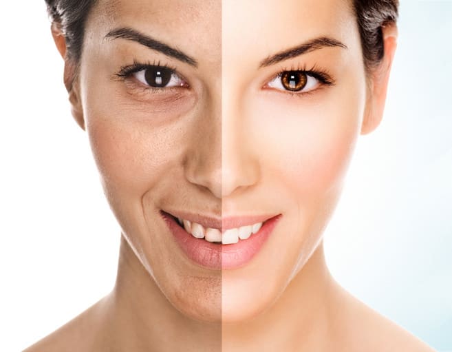 Cosmelan Peel Treatment reasult benefits cost price in mumbai malad