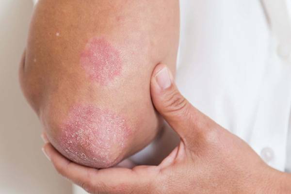 Best Fungal Infection treatment mumbai