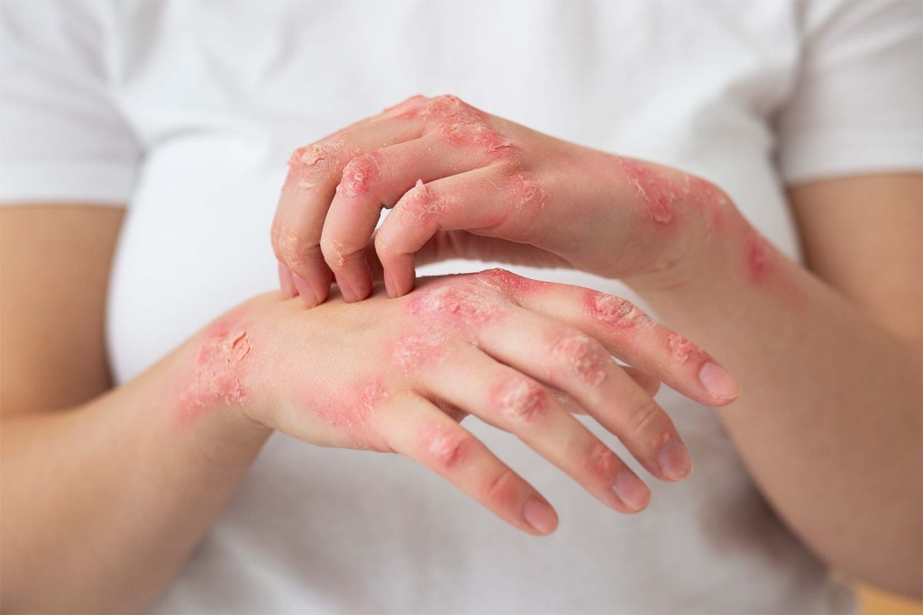 Best Eczema Clinic Malad