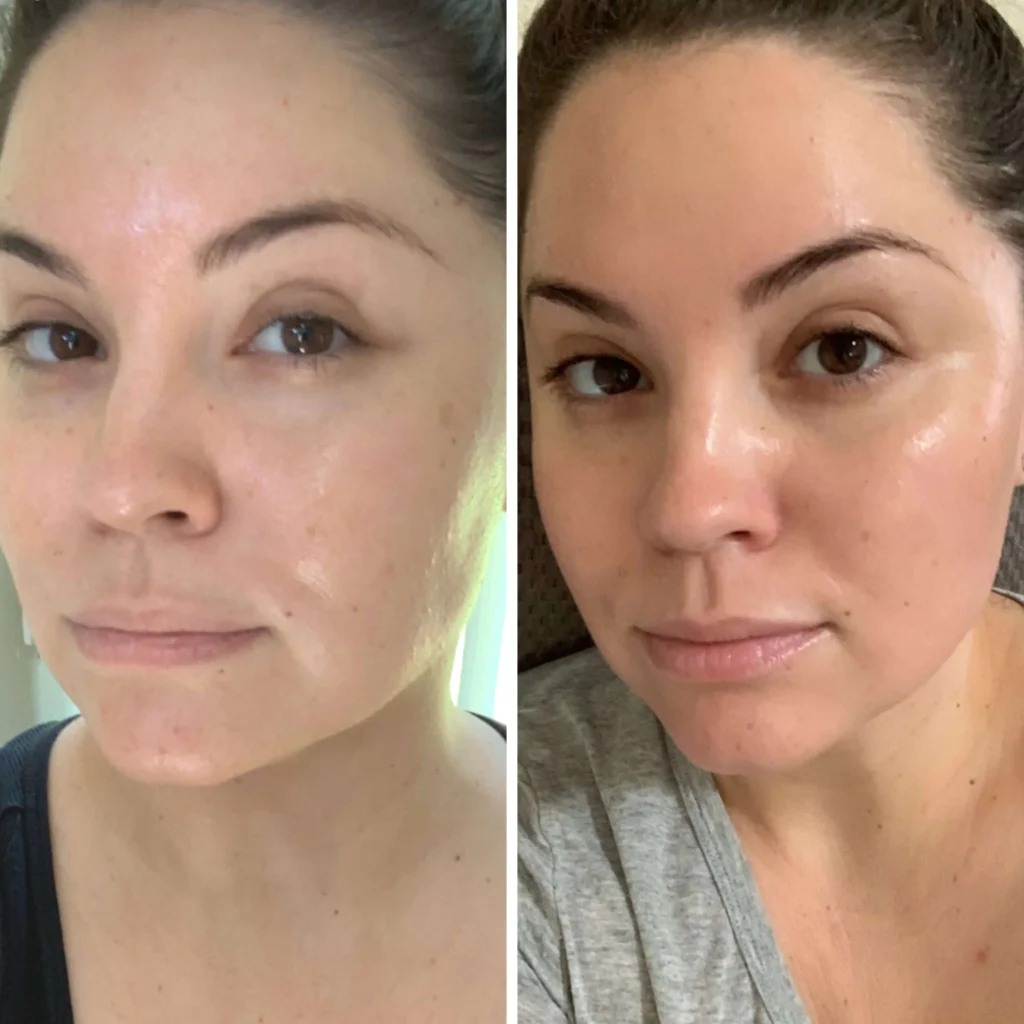 Chemical Peels for Acne PIH Glow Results benefits cost price in Malad mumbai