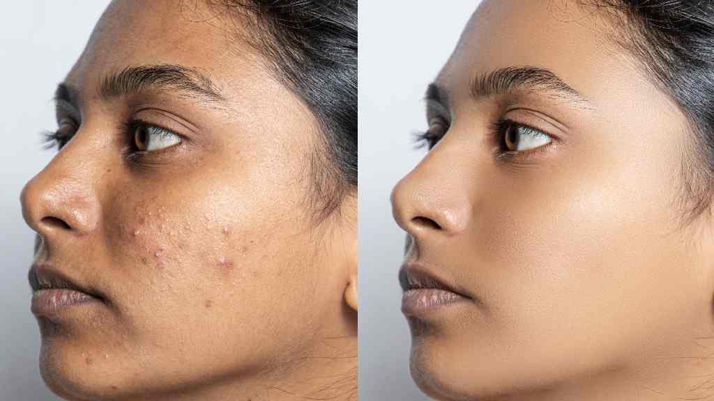 Skin Rejuvenation Treatment malad Mumbai