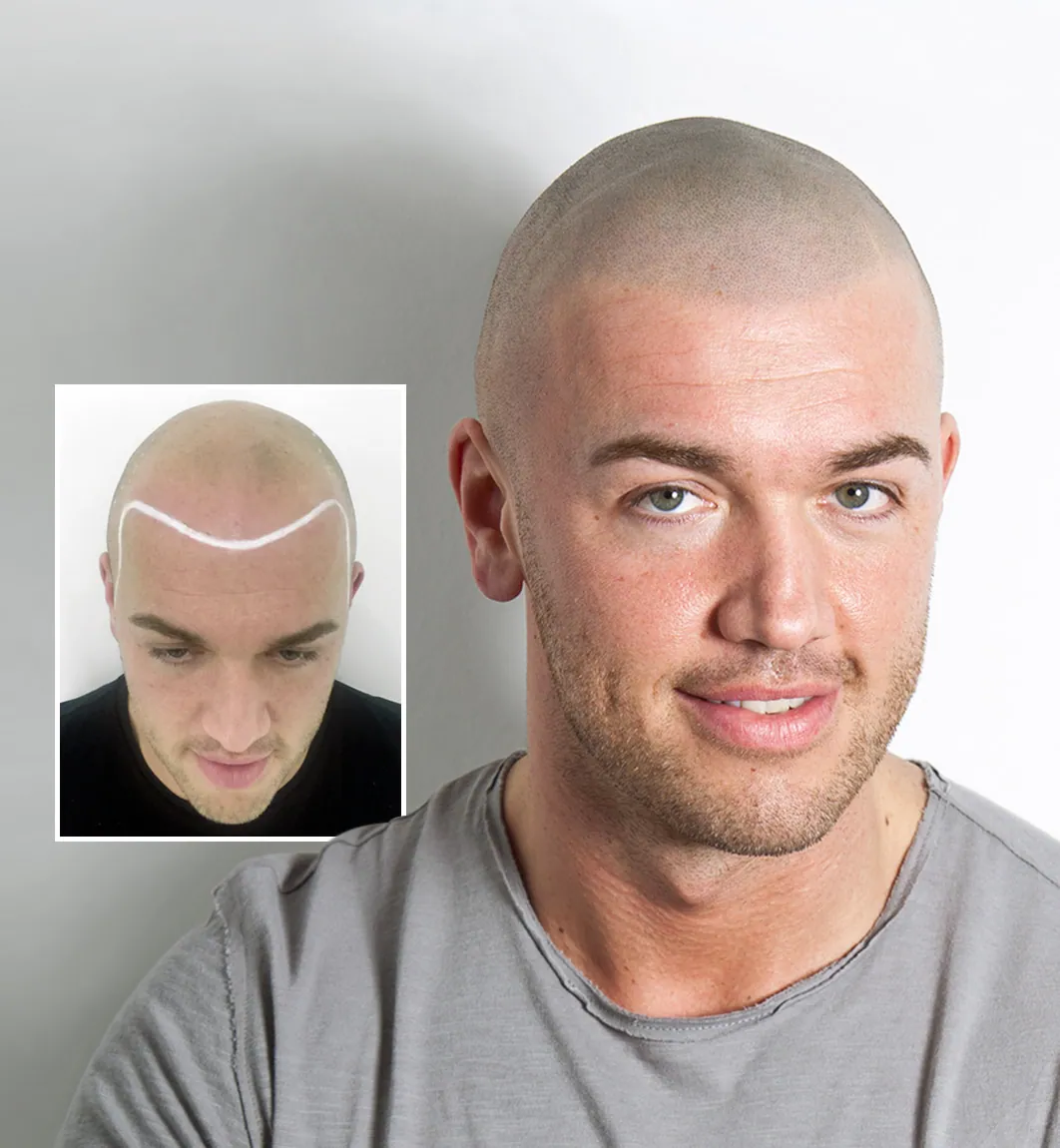 Scalp-Micropigmentation-best-clinic