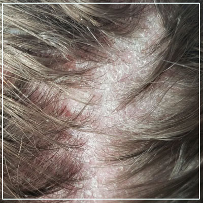 Seborrheic-Dermatitis-Treatment