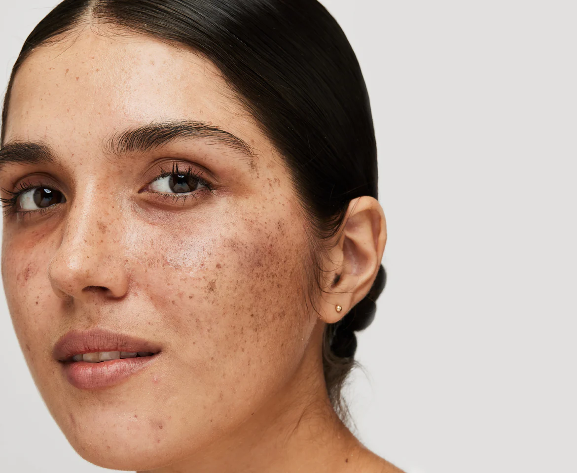 Q-Switch Laser for Melasma Mumbai