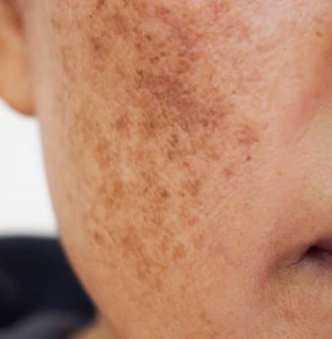 Q-Switch Laser for Melasma Mumbai