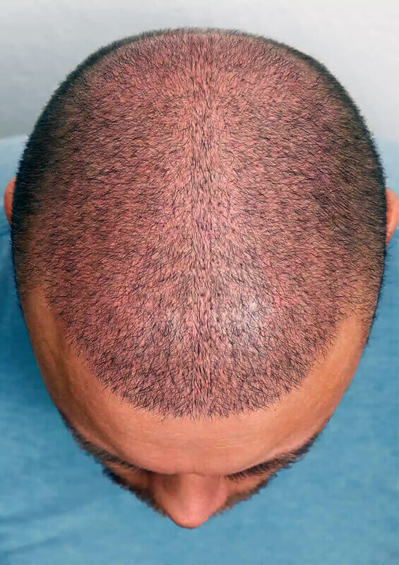 after-sapphire-fue-hair-transplant