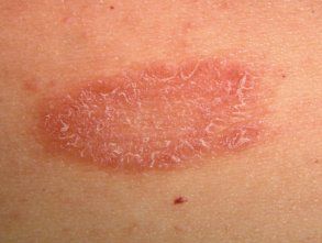 Fungal Skin Infection Diagnosis Malad Mumbai