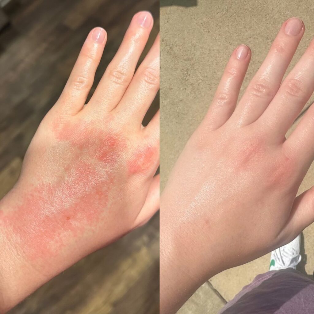 Psoriasis treatment Malad Mumbai