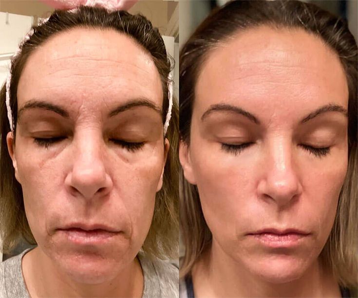 LED Therapy Results before after Malad Mumbai