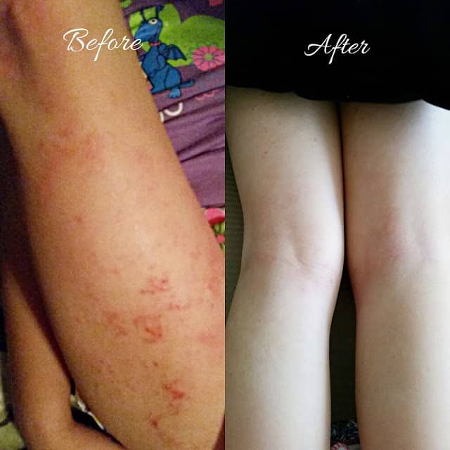 Before & after skin improvement from eczema treatment