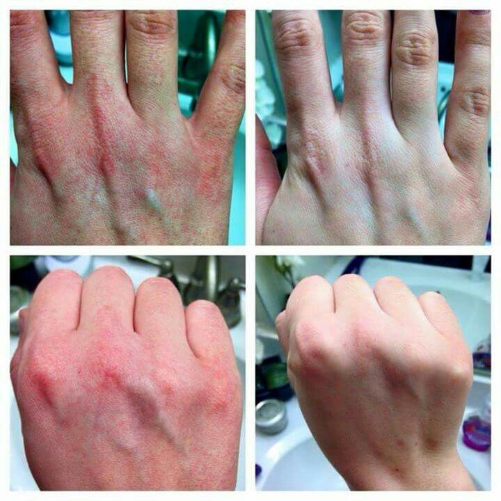 Eczema Relief Before After Mumbai