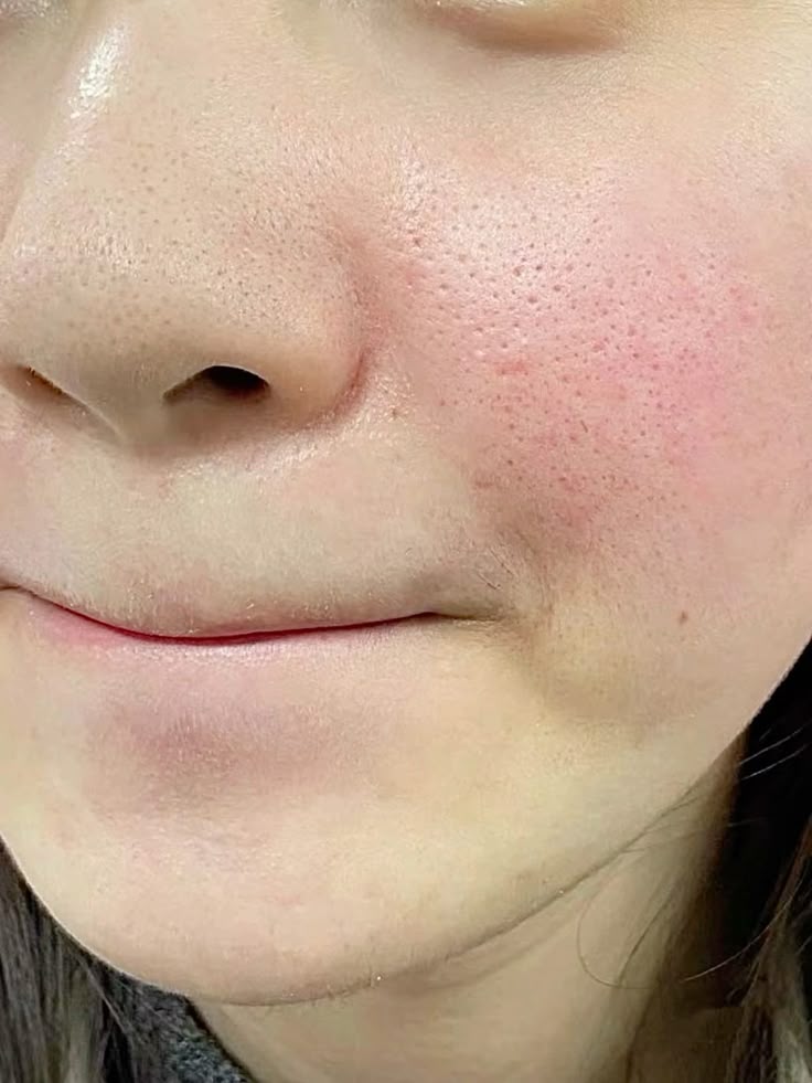 Best Pore Treatment Clinic Malad mumbai