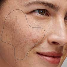 Dark Spots Treatment in Malad Mumbai