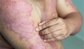 Best Eczema treatment in Malad mumbai