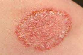 Best Fungal Infection Clinic Malad