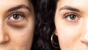 Best Dark Circles Clinic Malad mumbai