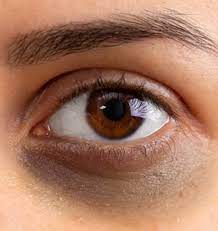 Dark Circles Treatment Malad Mumbai