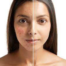 Acne Scars Removal Before and After Malad Mumbai