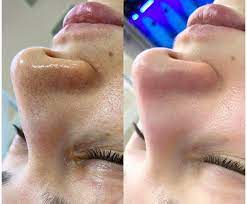 Deep Cleansing Facial Results Mumbai