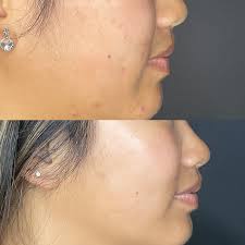 Oxygen Facial before after Results cost price Mumbai malad mumbai malad