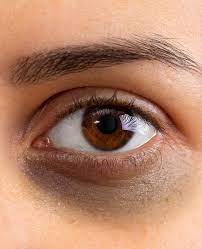 Under Eye Filler Treatment Mumbai