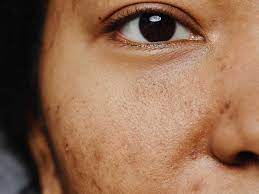 Best Pigmentation treatment Malad