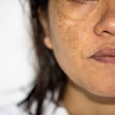 Dark Spots Treatment in Malad Mumbai