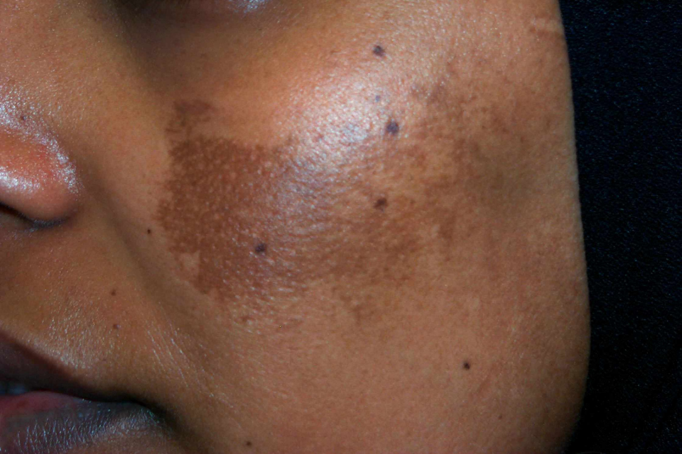 Best Melasma Clinic Malad