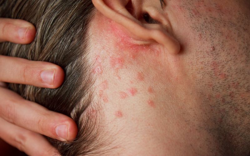Dermatologist for Psoriasis Malad