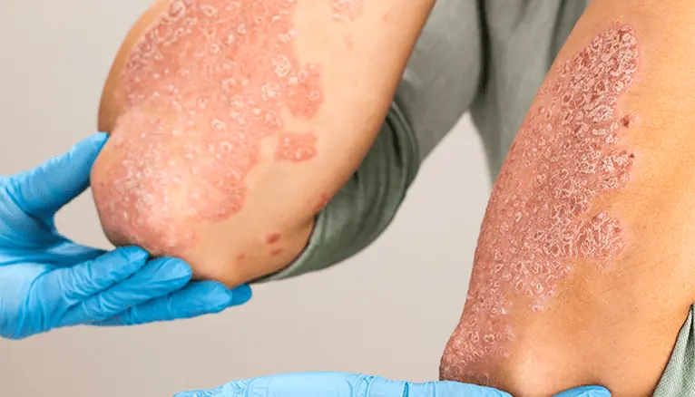 Dermatologist for Psoriasis Malad