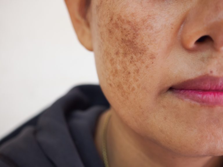 Laser Treatment for Dark Spots Mumbai