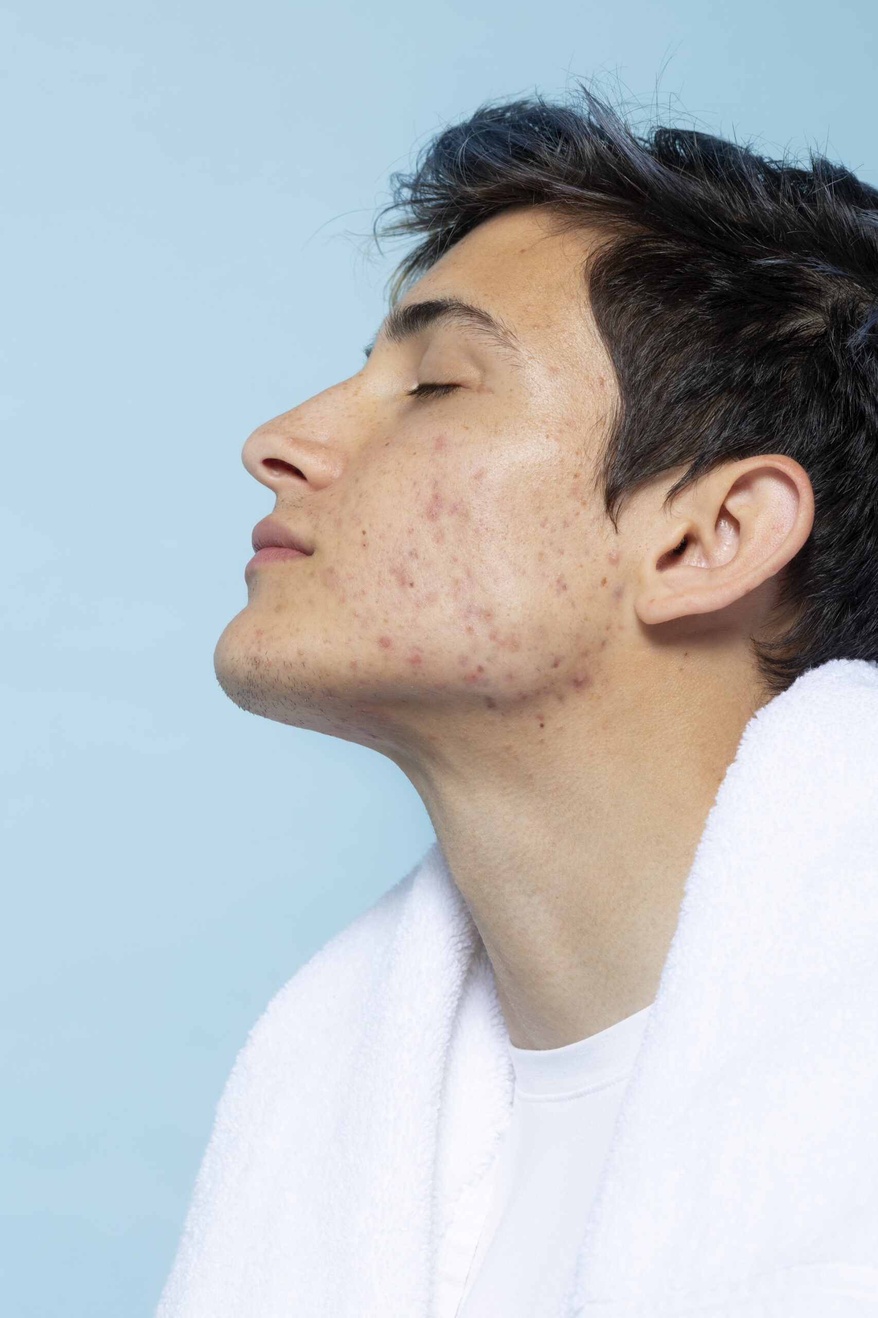 Q-Switch Laser for Melasma Mumbai