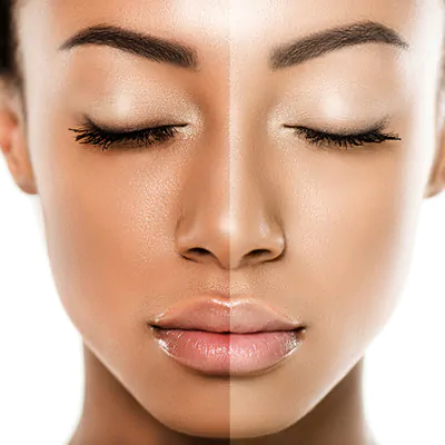 Best Skin Lightening Clinic Malad mumbai
