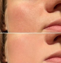 Open Pores Reduction Before After Malad Mumbai