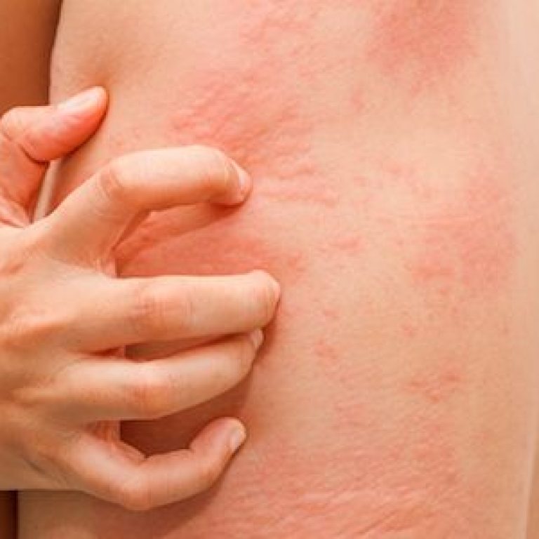 Skin Rash treatment Malad Mumbai