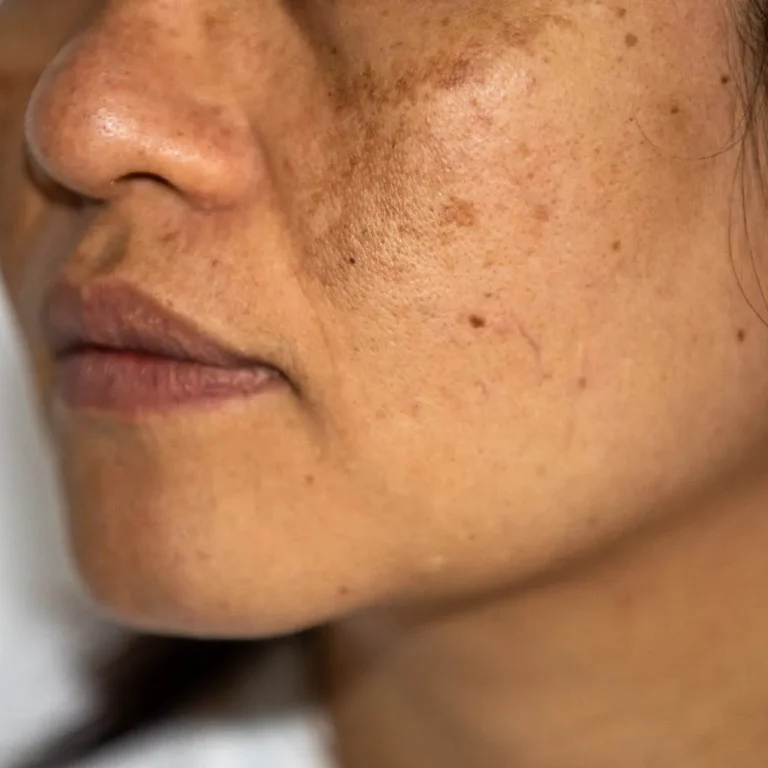 Best Pigmentation Clinic Malad
