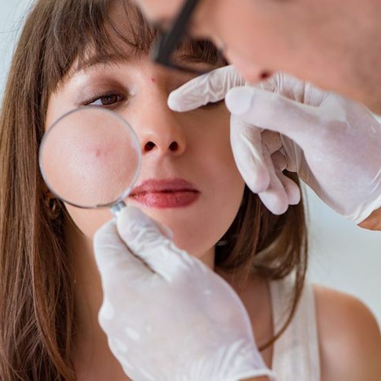 Best Acne Doctor in Malad Mumbai