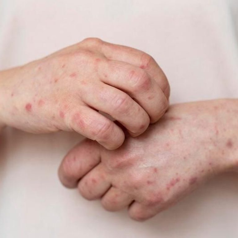 Best Eczema Clinic Malad
