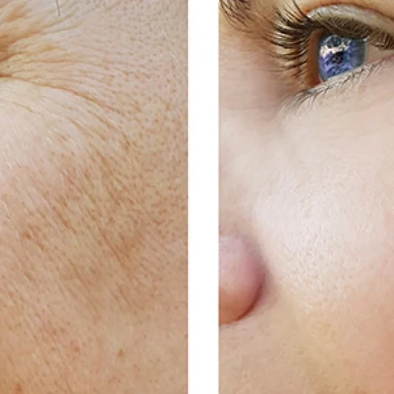 Skin Rejuvenation treatment Malad Mumbai